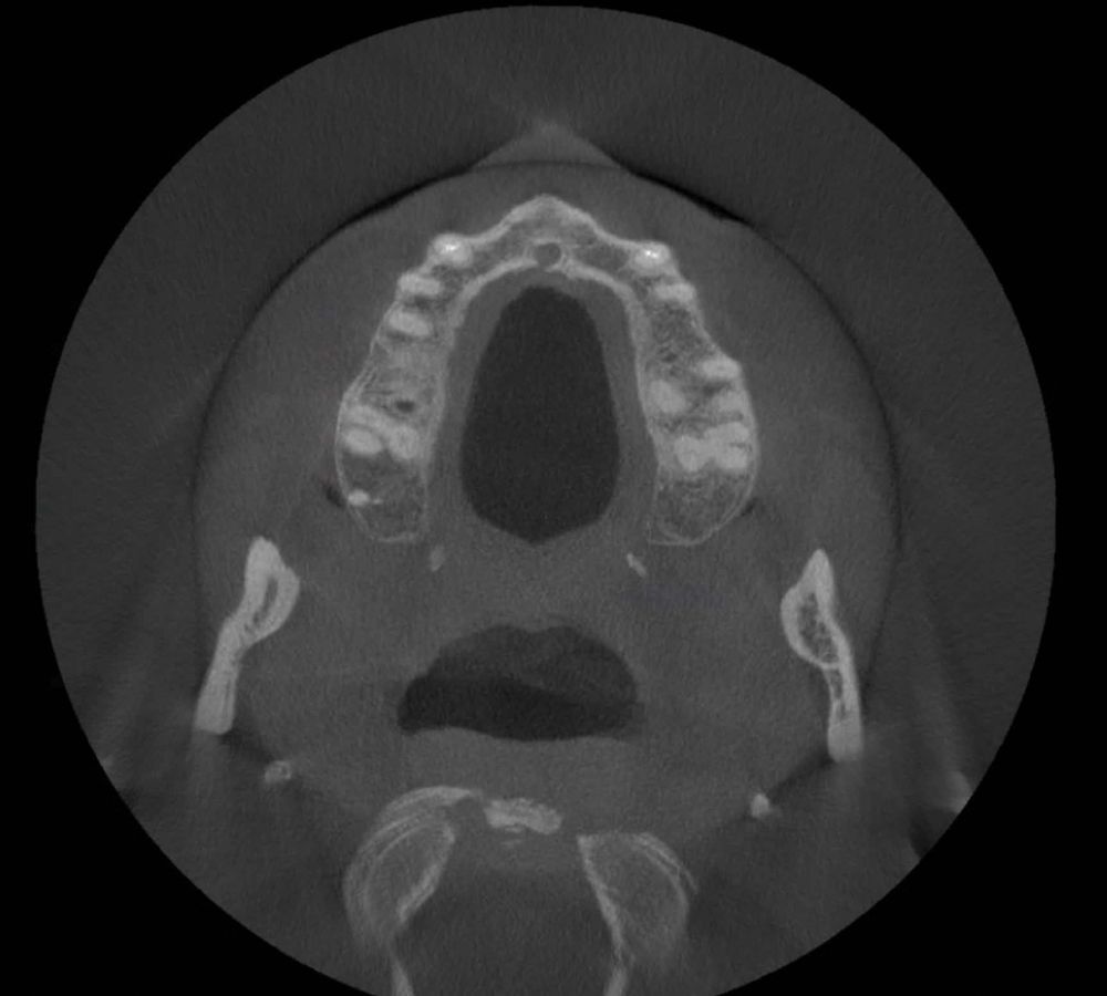 A PreXion CBCT scan was obtained in my practice to determine the placement and the number of implants that were possible 
