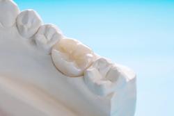 Zirconia Materials Market to Exceed $297.7 Million This Year, and Here's Why 