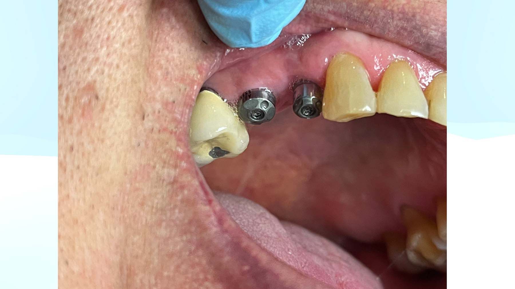 Figure 7. The healing abutment implant site #4 and #5