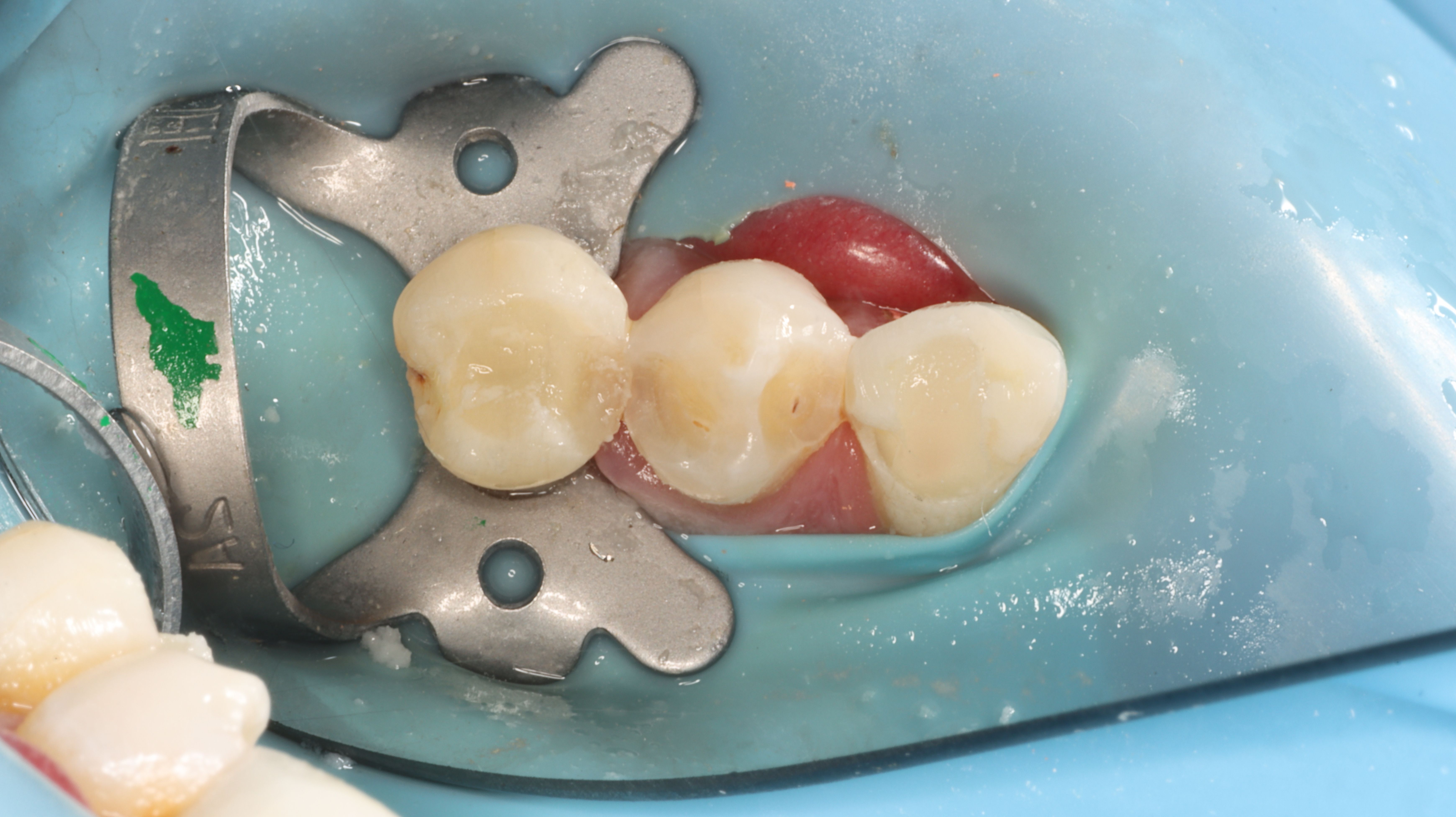 Figure 7. Pre-op EndoPilot isolation.