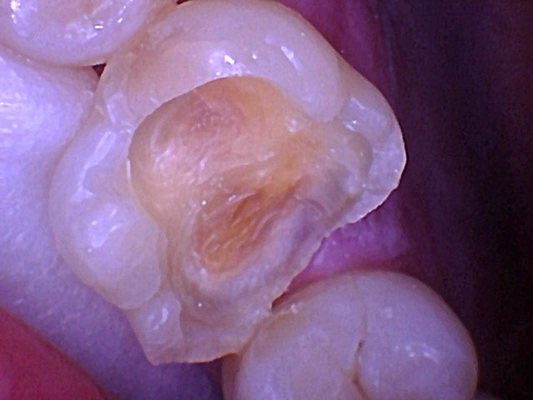 Figure 6.  Upon removal of all decay and dermal-epidermal junction staining, I was relieved to discover no pulpal exposure, but I was eager to use a bioactive restorative product due to the proximity of the restoration to the pulp.