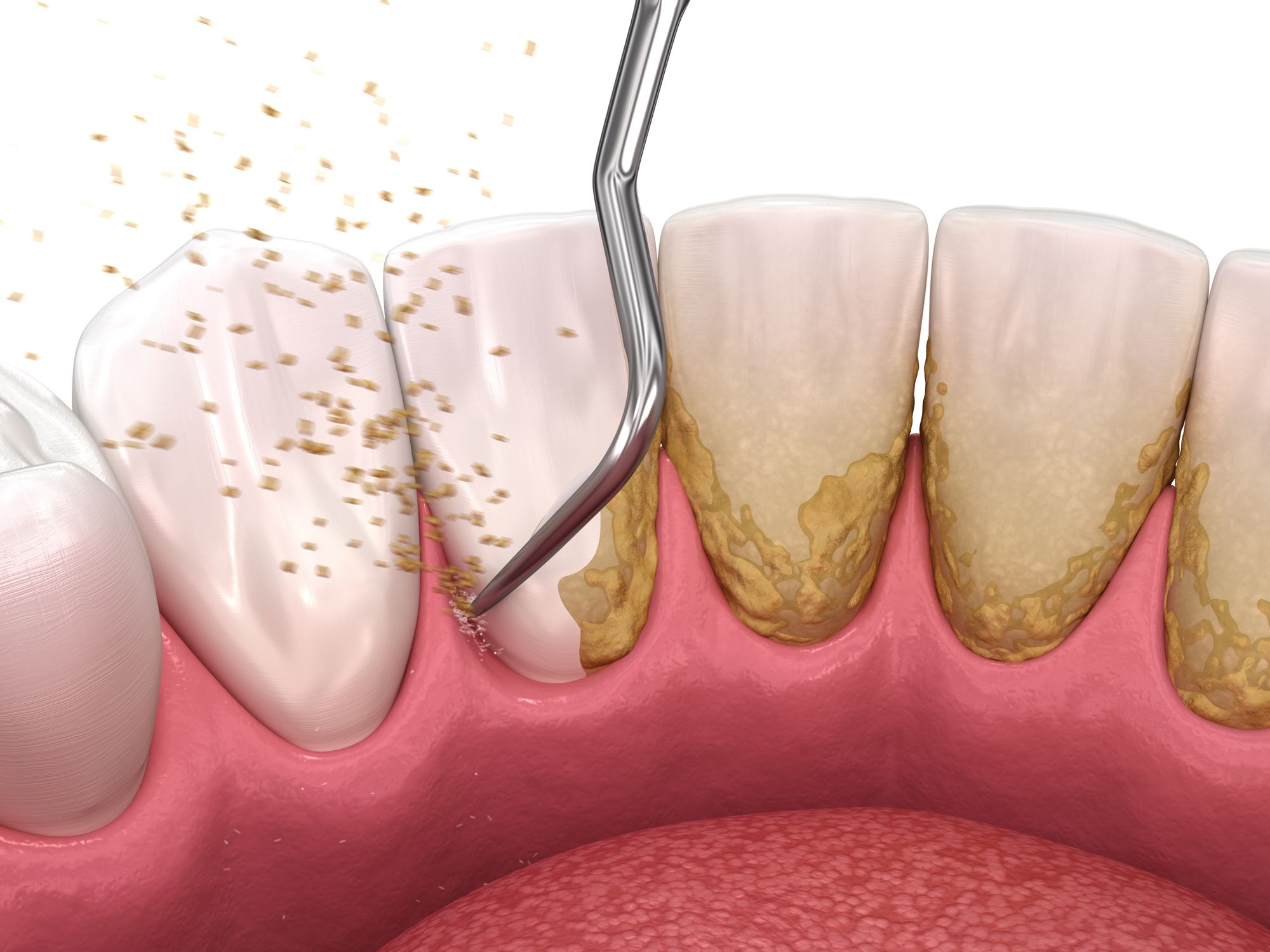 The Evolution of Nonsurgical Periodontal Therapy: A Three-Part Series by Lynne H. Slim, MS, RDH; and Suzanne Newkirk, RDH