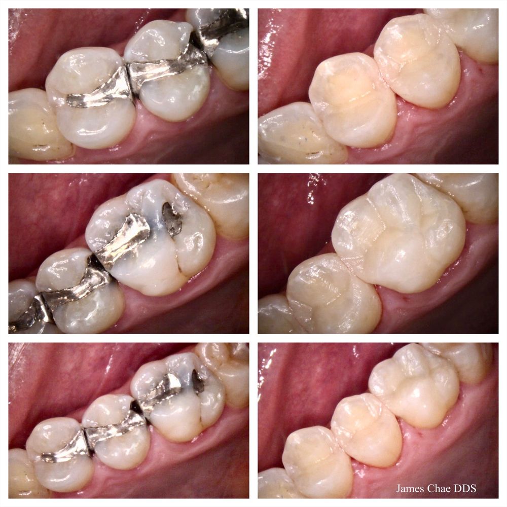 How to Repair Amalgam Restorations With Recurrent Caries