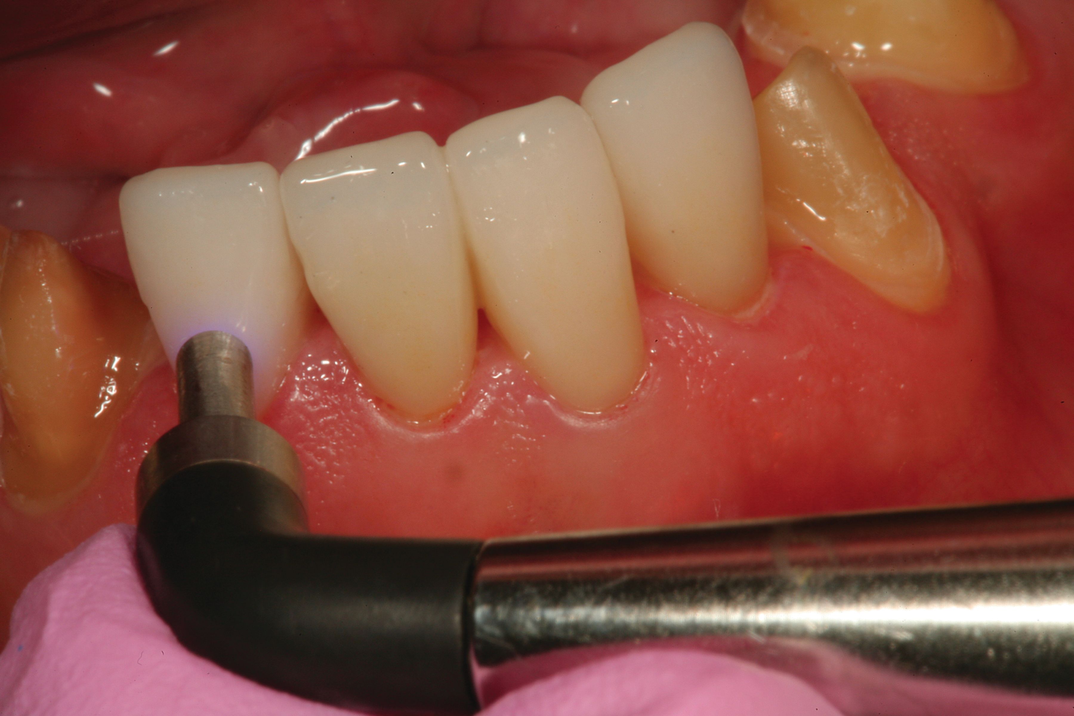 How to use the Universal Bond system for a perfect, predictable fit