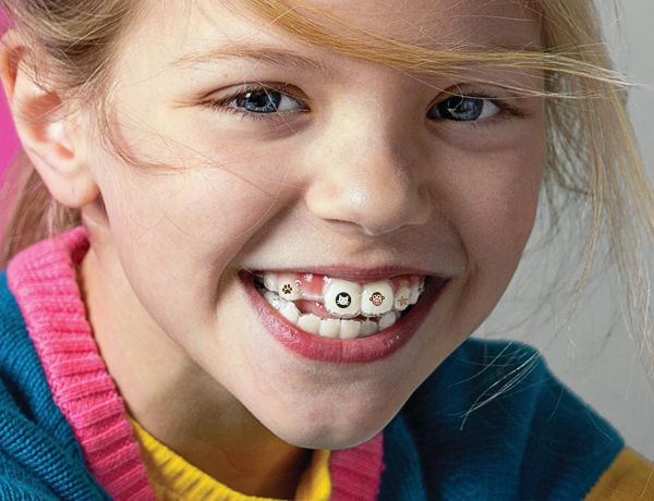 Invisalign Stickables