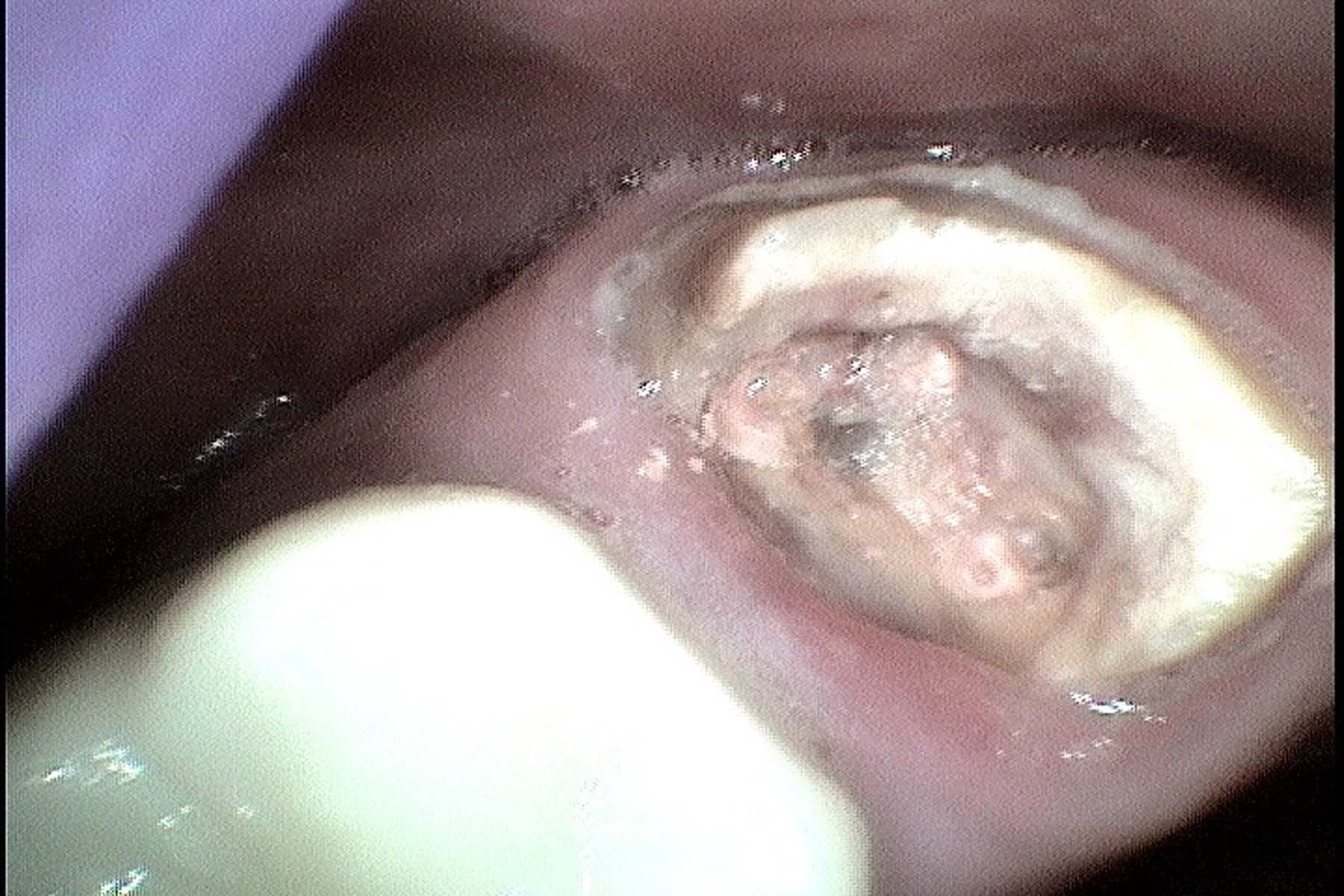 Figure 11. Tooth #15: history of root canal treatment and crown.