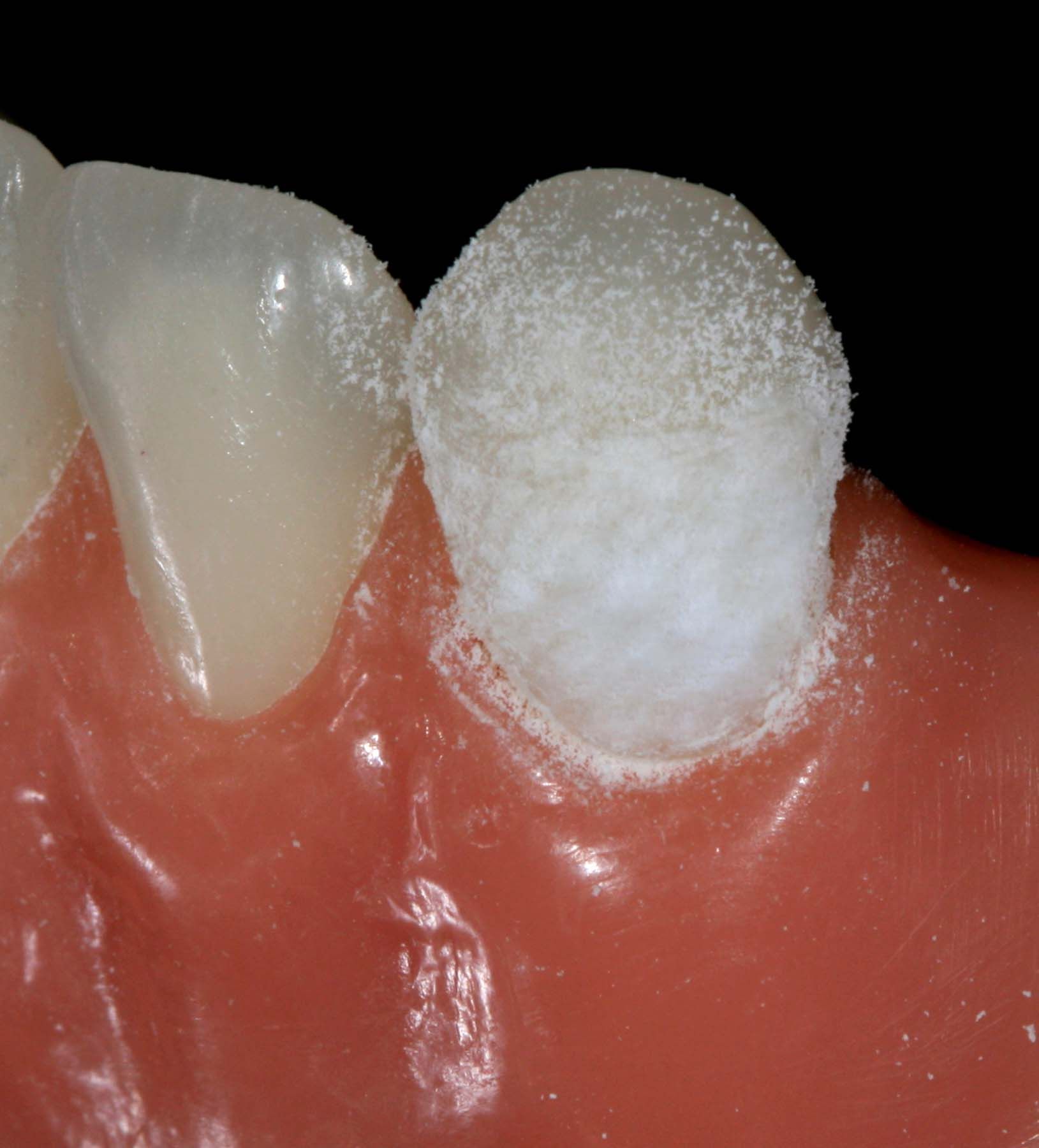 Figure 14. Precontouring with Red Scout Diamond