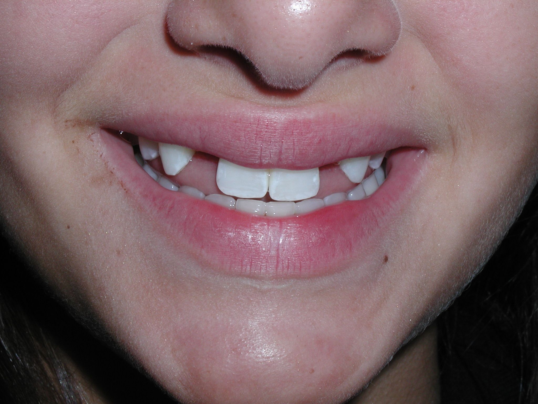 Understanding of Genetic Tooth Malformation Could Help Develop Future ...