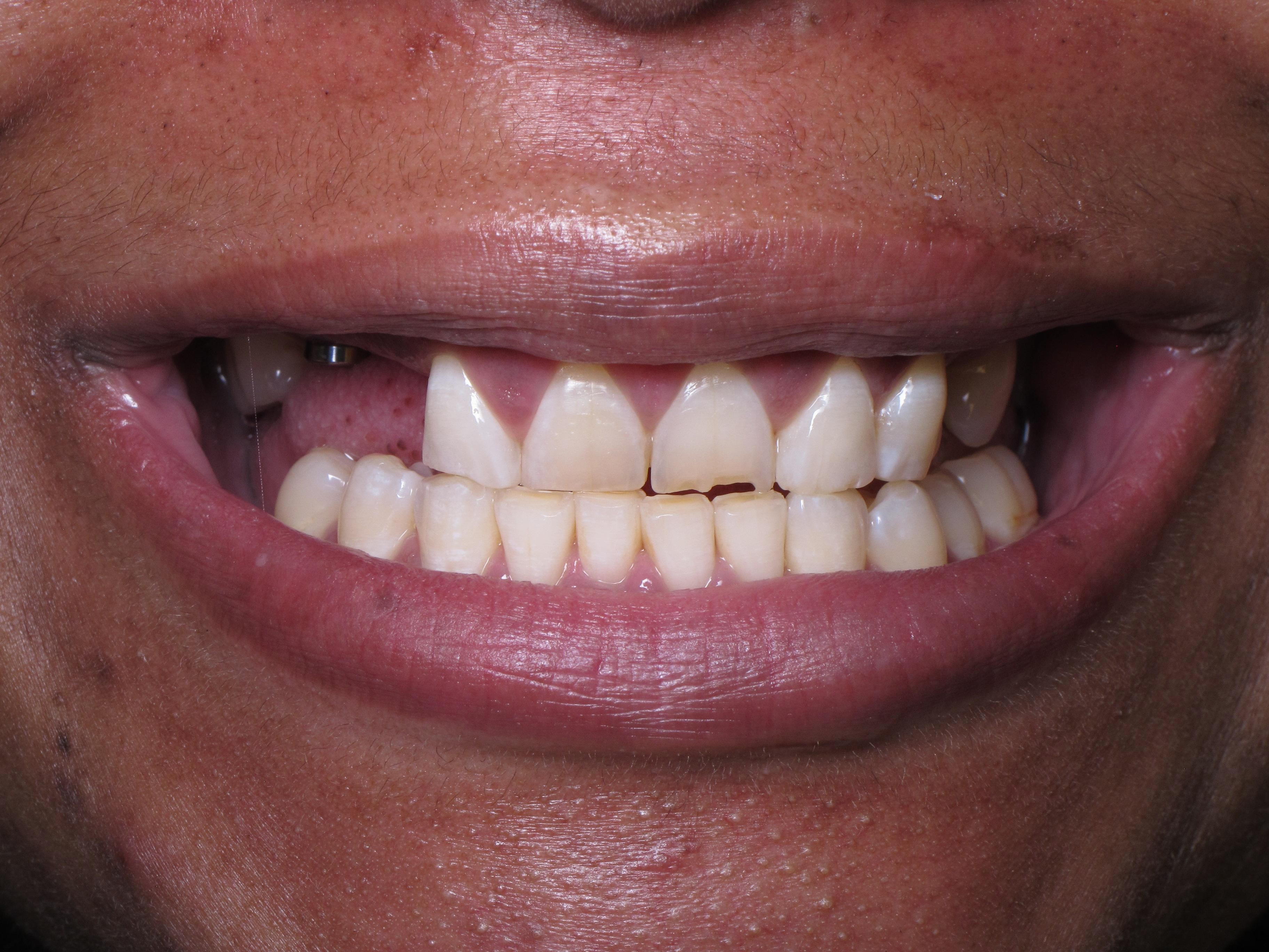 Figure 2. Moderate tissue display in the Duchenne smile. 