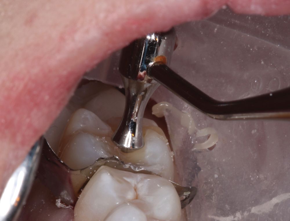 Featured product: The Occlusinator System