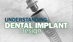 Understanding Dental Implant Design
