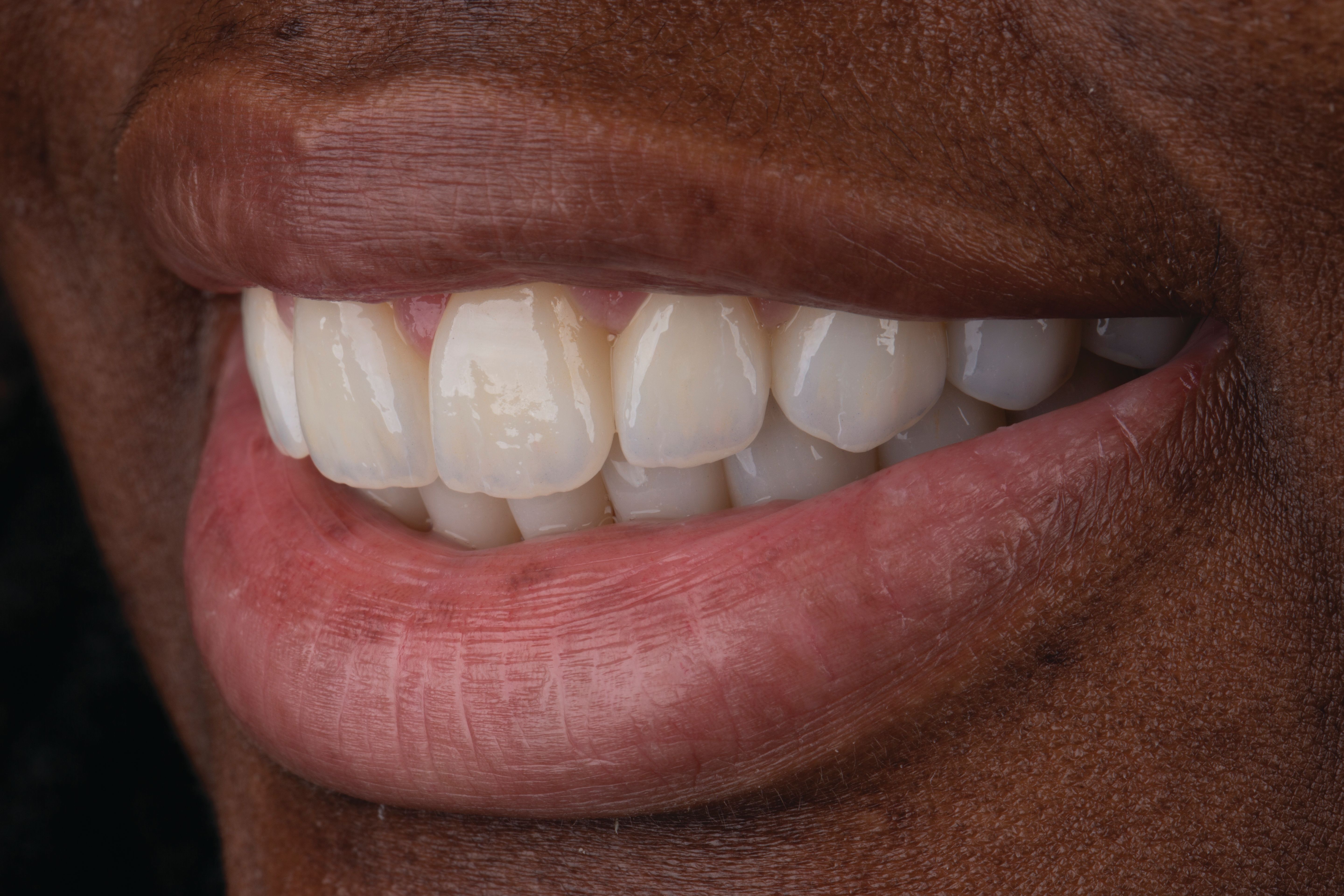 Figure 3: The soft-tissue response to zirconia restorations is comparable to the soft tissue around natural teeth, providing long-term gingival health.