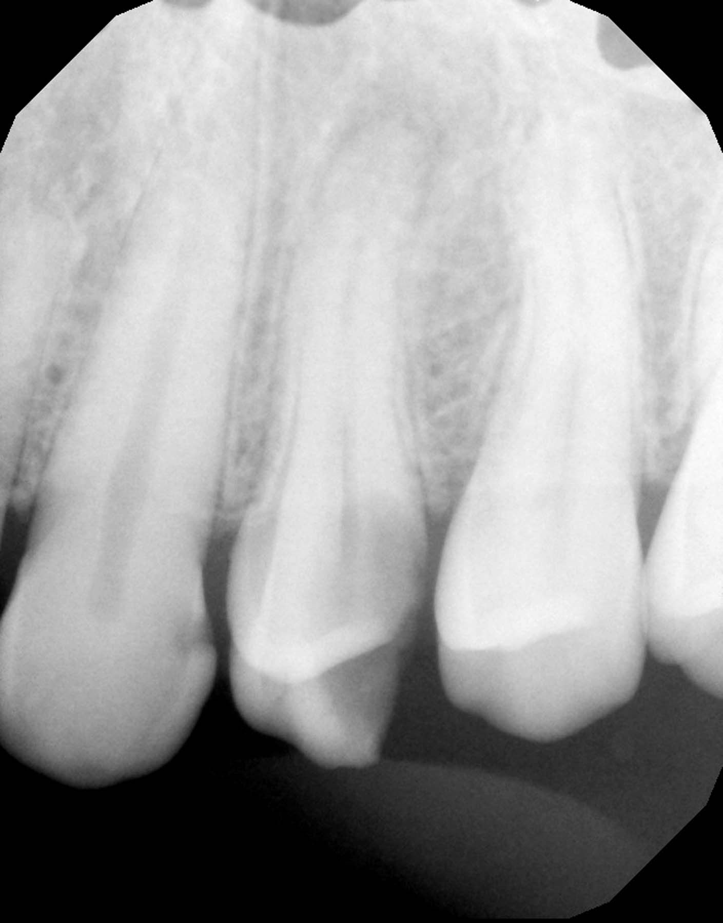 Figures 1-2.  Case 1, a 34-year-old man. Patient presented in need of extraction of #12 following a chronic apical abscess that led to a large swelling extending to the orbit. Clinical images courtesy of  Ross Isbell, DMD, MBA 