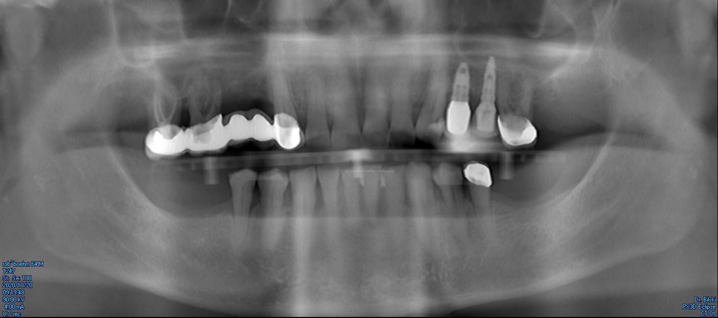 Figure 1. Pre-op panoramic image showing severe periodontitis.