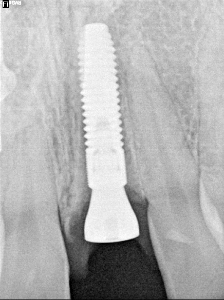 X-ray of final dental implant placement