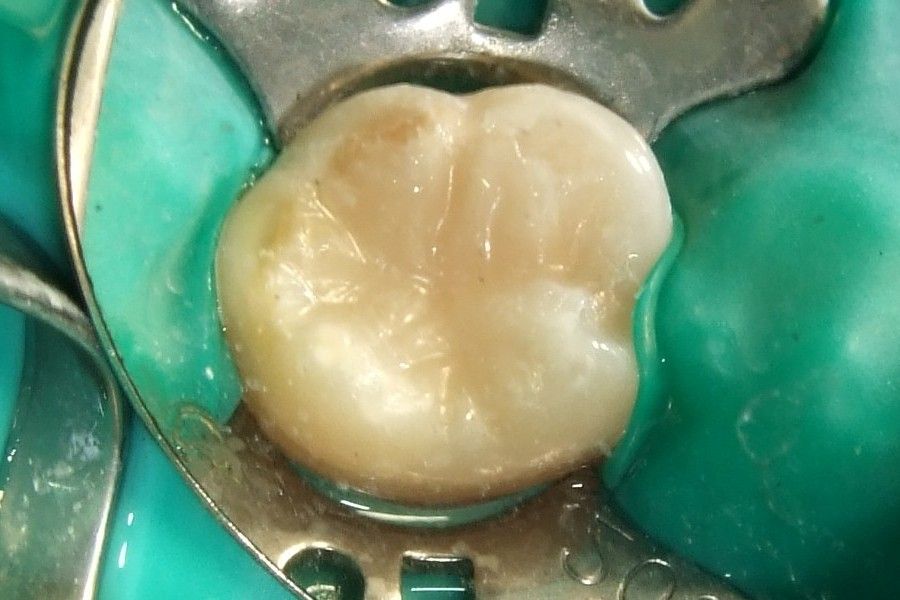 dental composite filling