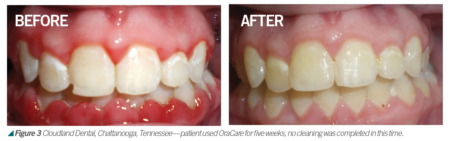 We May Be Headed Toward A New Mouthrinse Protocol We May Be Headed Toward A New Mouthrinse Protocol