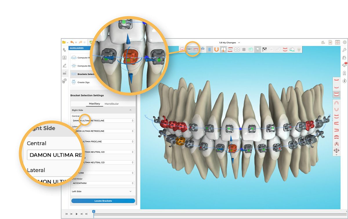 Ormco Unveils Orthodontic Solution Ormco™ Digital Bonding
