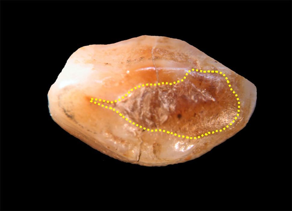 Image: © Bernardini F, Tuniz C, Coppa A, Mancini L, Dreossi D, et al. (2012) Beeswax as Dental Filling on a Neolithic Human Tooth. PLoS ONE 7(9): e44904. doi:10.1371/journal.pone.0044904