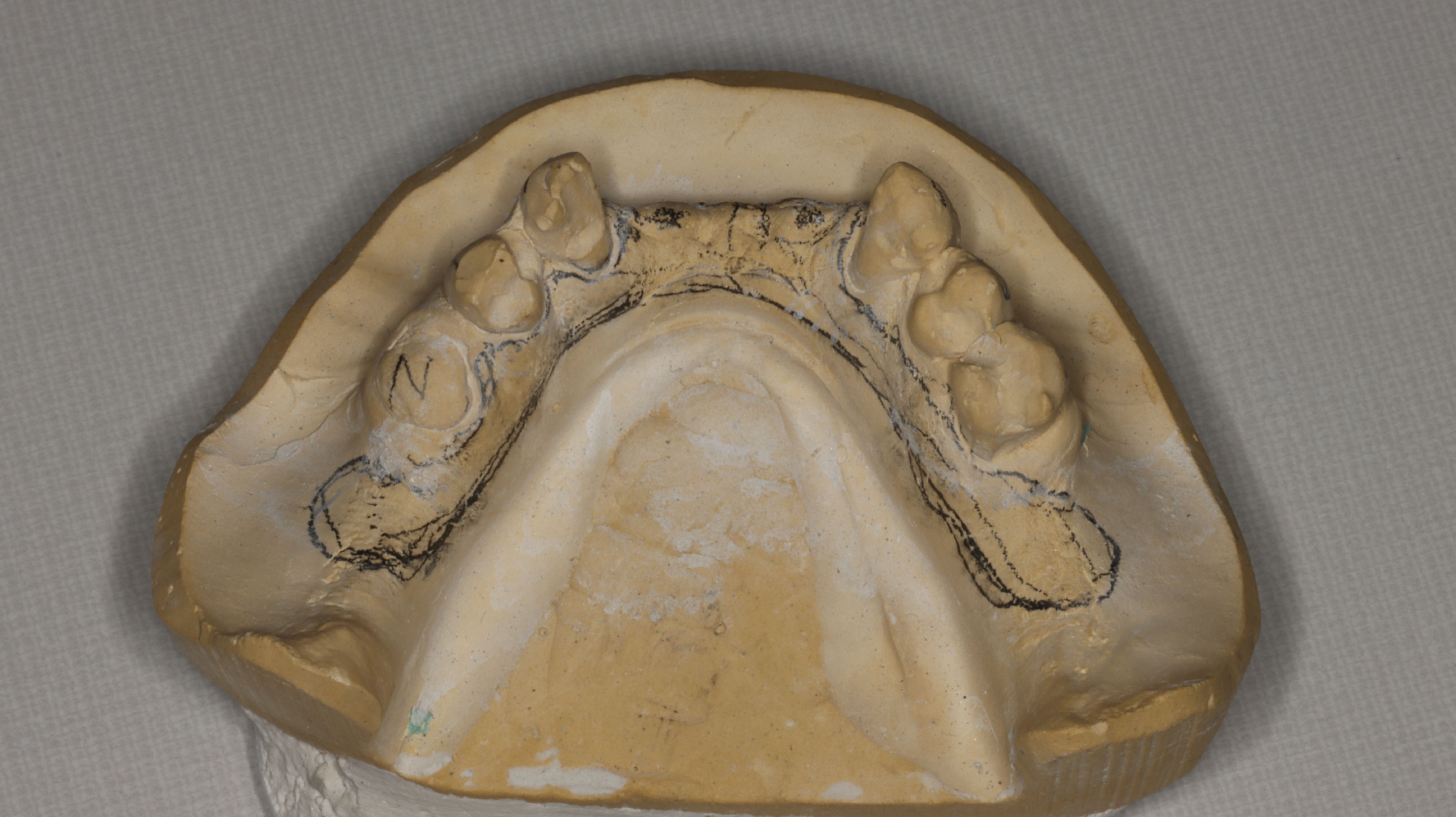 Figure 12. Stone cast and design for cast metal reinforcement incorporated into mandibular overdenture.