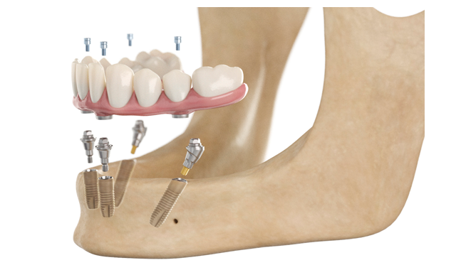 Dentsply Sirona Implants to present several new solutions to their 