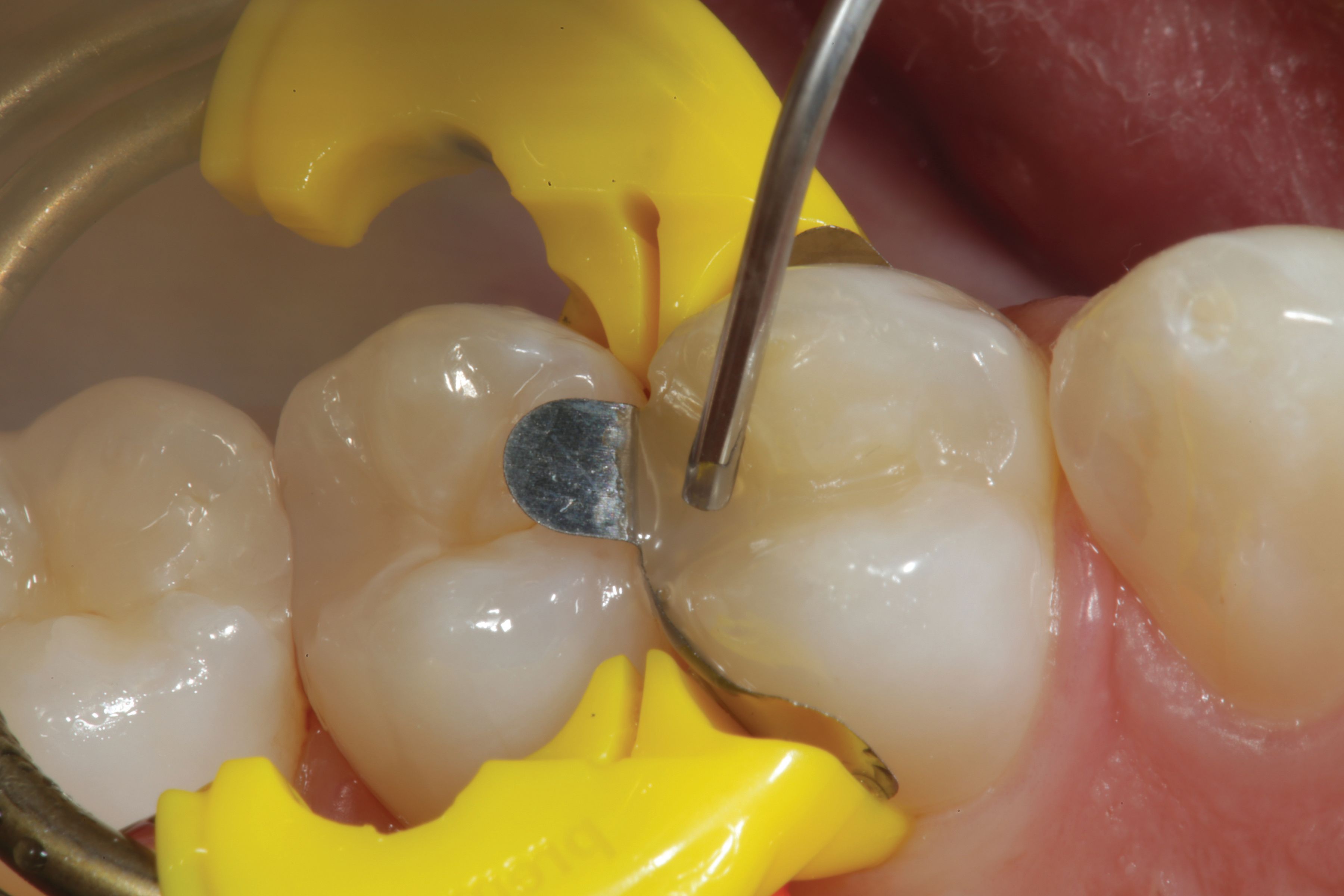 How to Bulk Fill Flowable Composite Restorations Without a Capping Layer