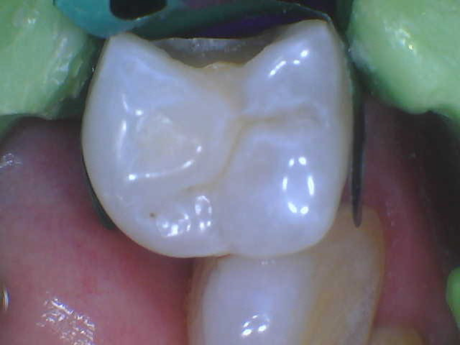 This Instrument Boosts Interproximal Finishing