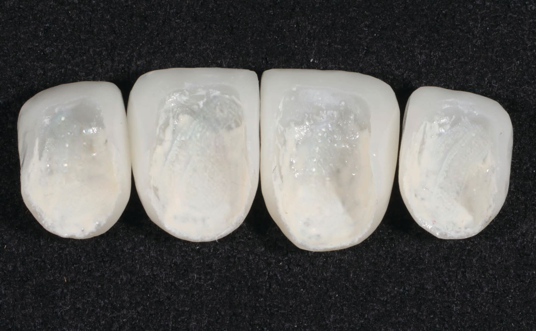 Figure 22. IPS e.MAX incisors ready to seat. 