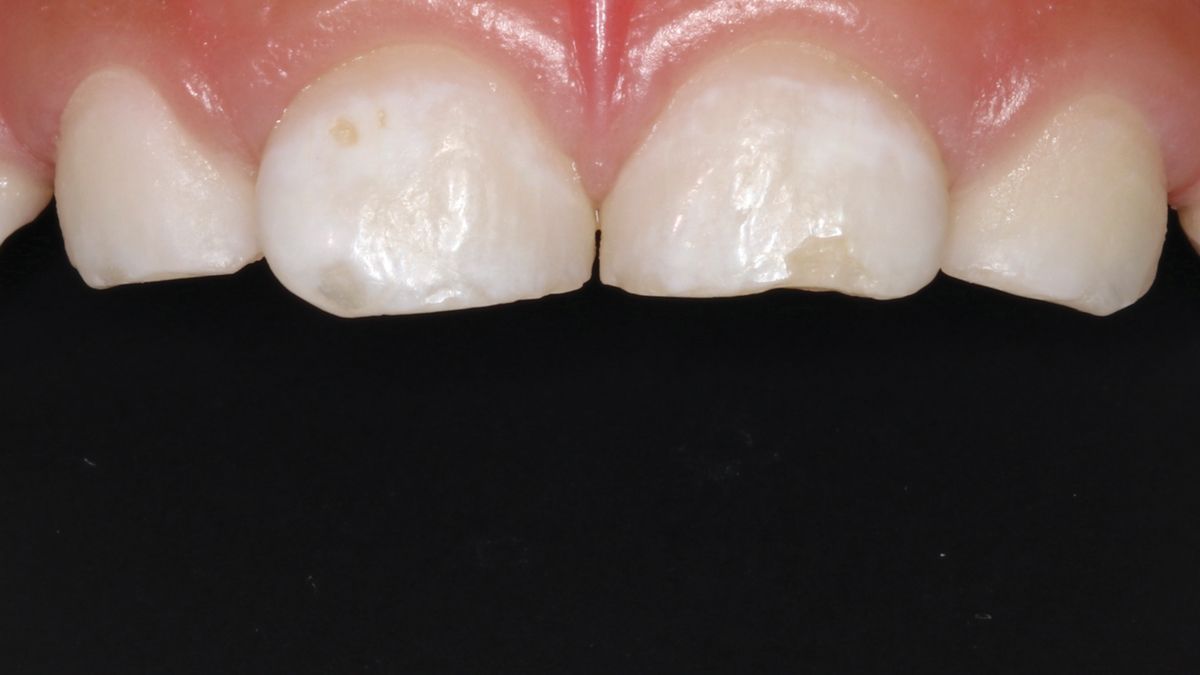 Case 2 Figure 1 4-year-old patient with primary central incisor with a small carious lesion manageable with a tiny restoration