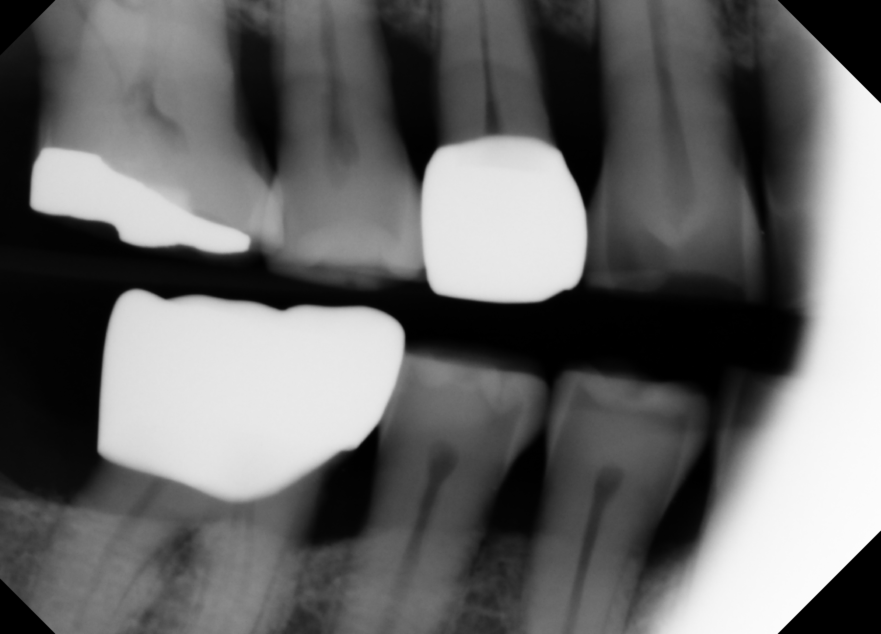 Figure 5. A postop cementation radiograph. | Image Credit: © Ben Alvarez, DDS