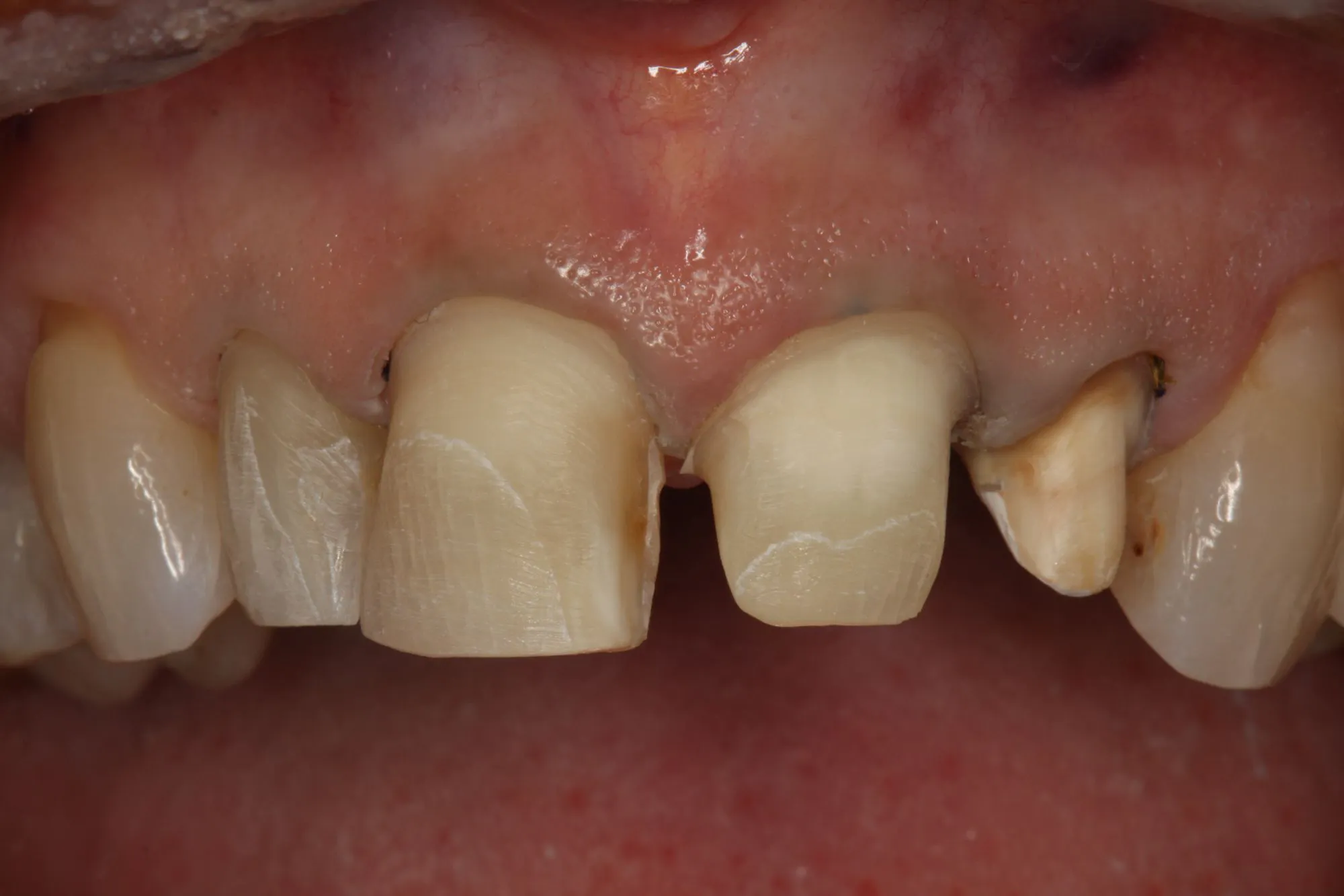 After the retraction paste is rinsed off, there is a clean, dry field optimized for the impression process. |  Image © Gary Radz