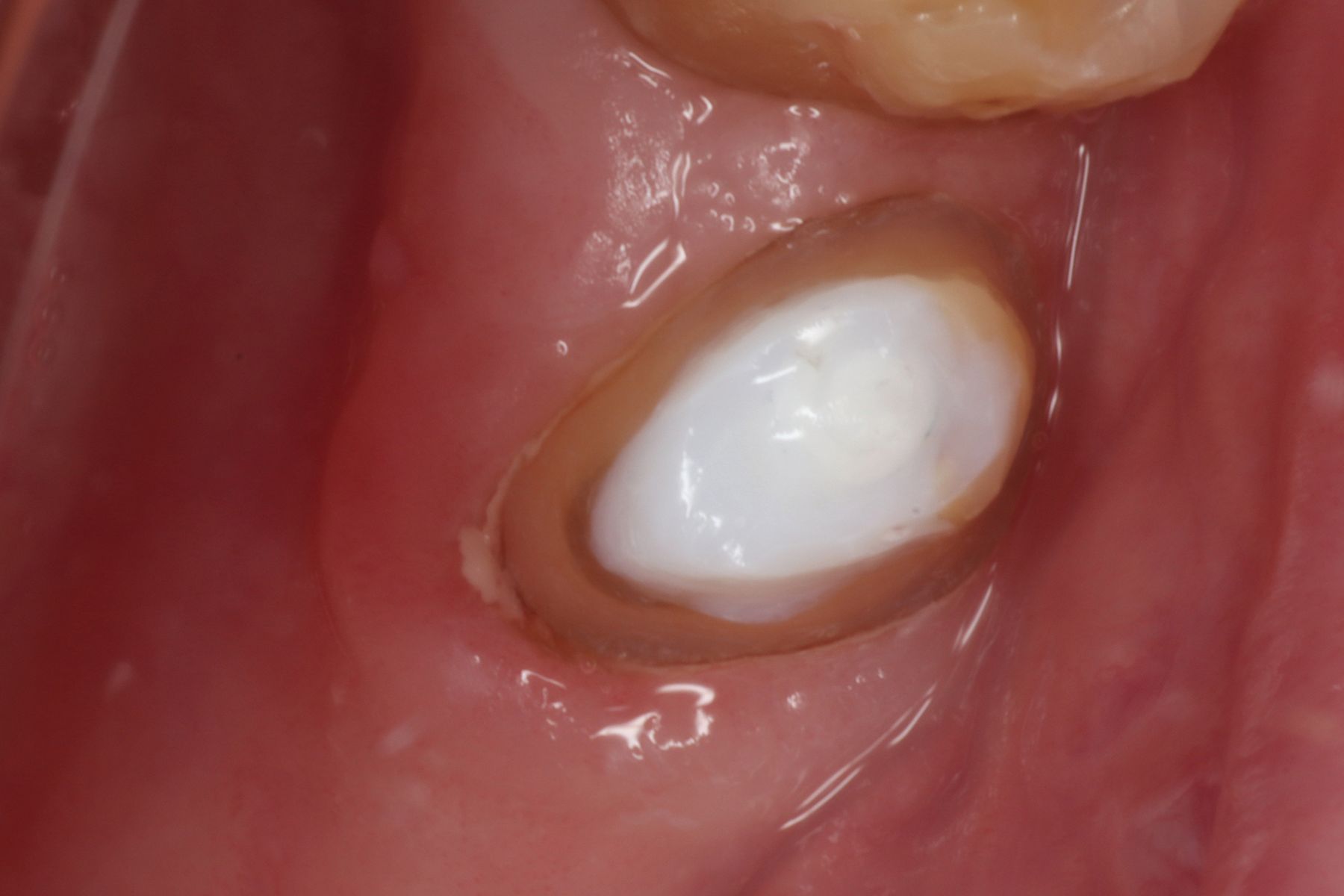 Splendor-SAP From Angelus Dental: Unique and Versatile Post System