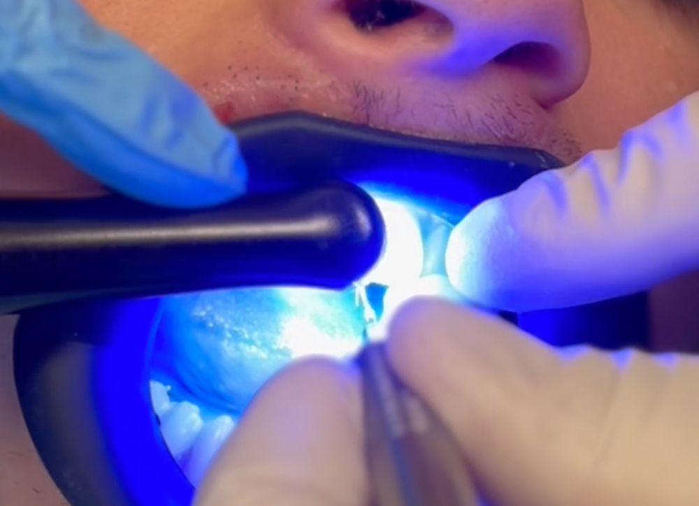  The composite was quickly manipulated into place using a composite placement instrument and cured using an LED curing light.