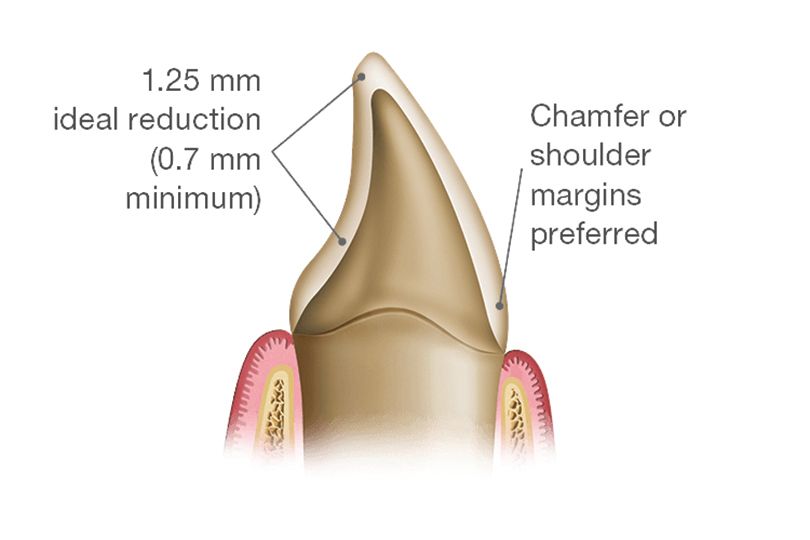Figure 1: For adequate reduction, understand the minimal preparation requirements of the restorative material.