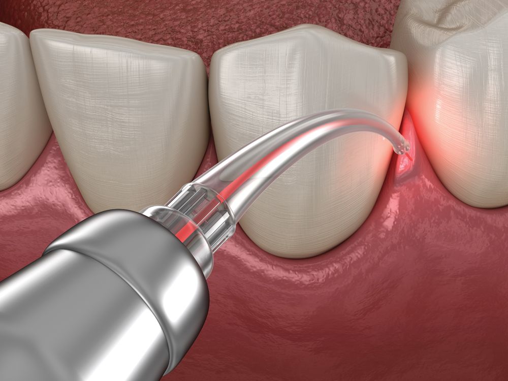 Diode laser roundup