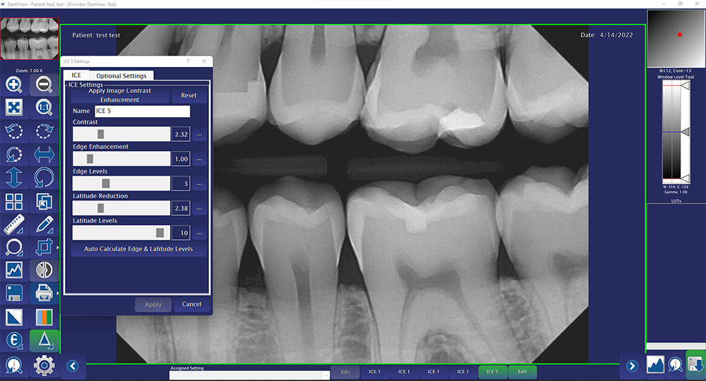 Adjusting the sharpness of a dental x-ray