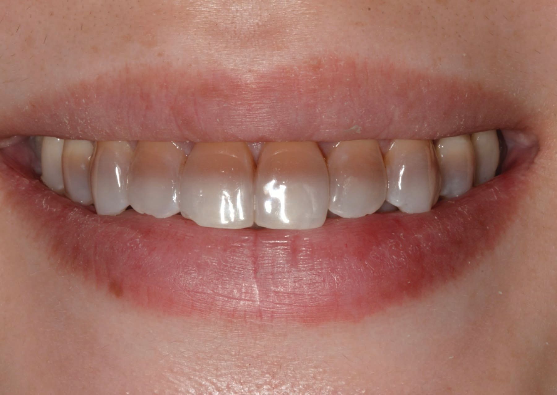 Figure 2. Preoperative 1:2 image of smile.