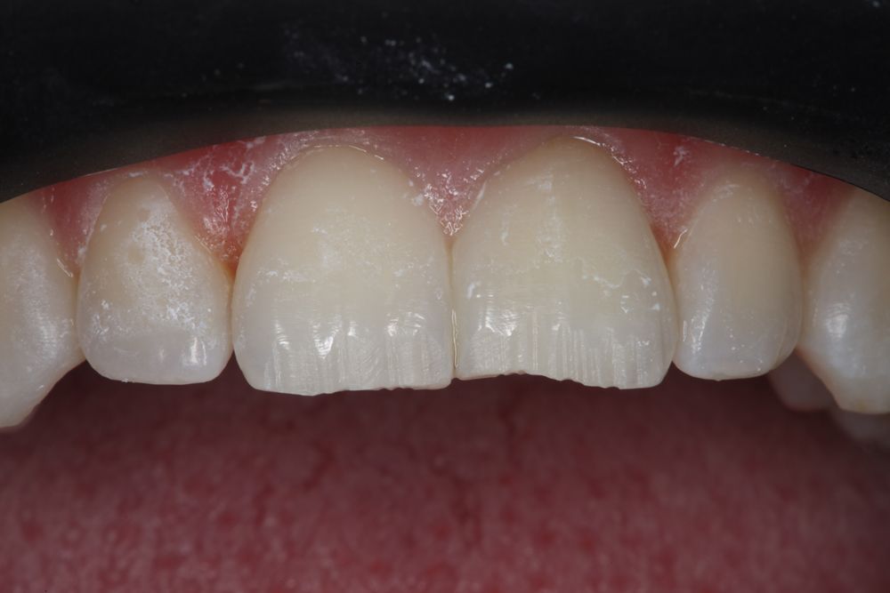Prior to anesthesia and tooth preparation, the putty matrix was tried in to confirm proper seating and fit, and composite shades were selected. Teeth #8 and #9 were prepared using a pointed diamond bur, establishing an irregular bevel along the incisal ¹/3 of each incisor.