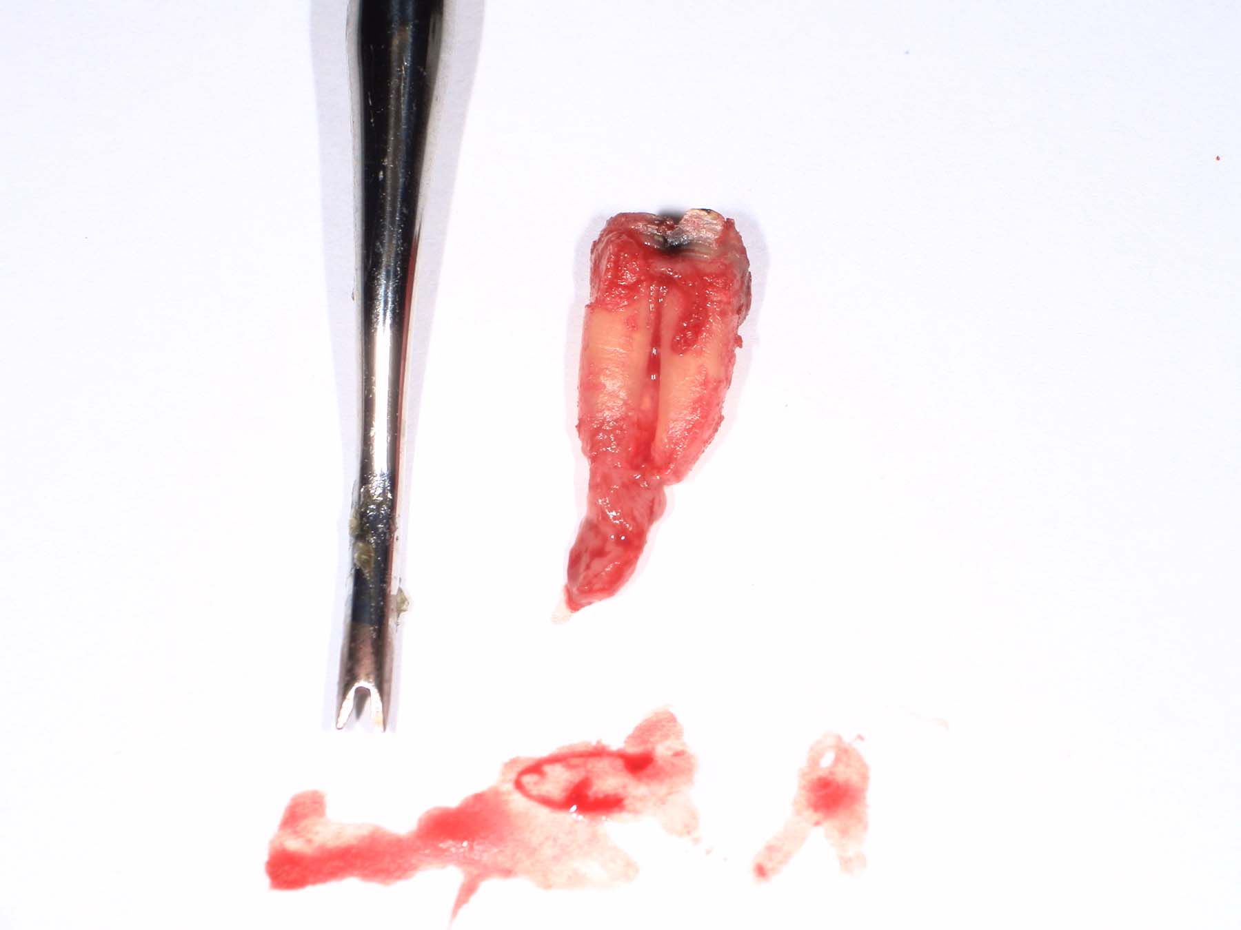 Figure 5. Attempt to deliver the tooth with a set of 150 forceps led to the coronal portion fracturing.