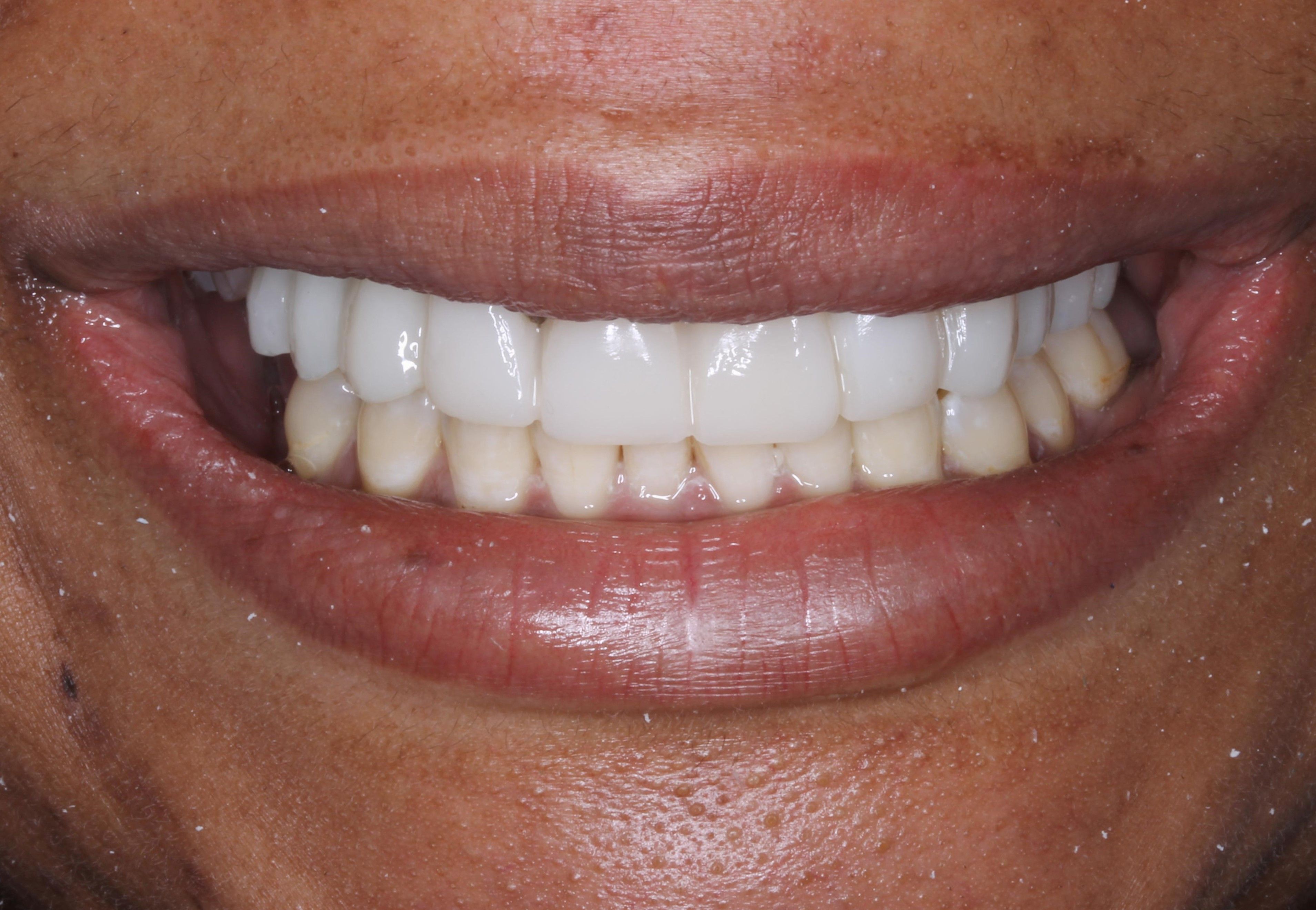 Figure 5. The patient’s full-mouth rehabilitation was made possible by both Structur CAD and GrandioSO flowable from VOCO.