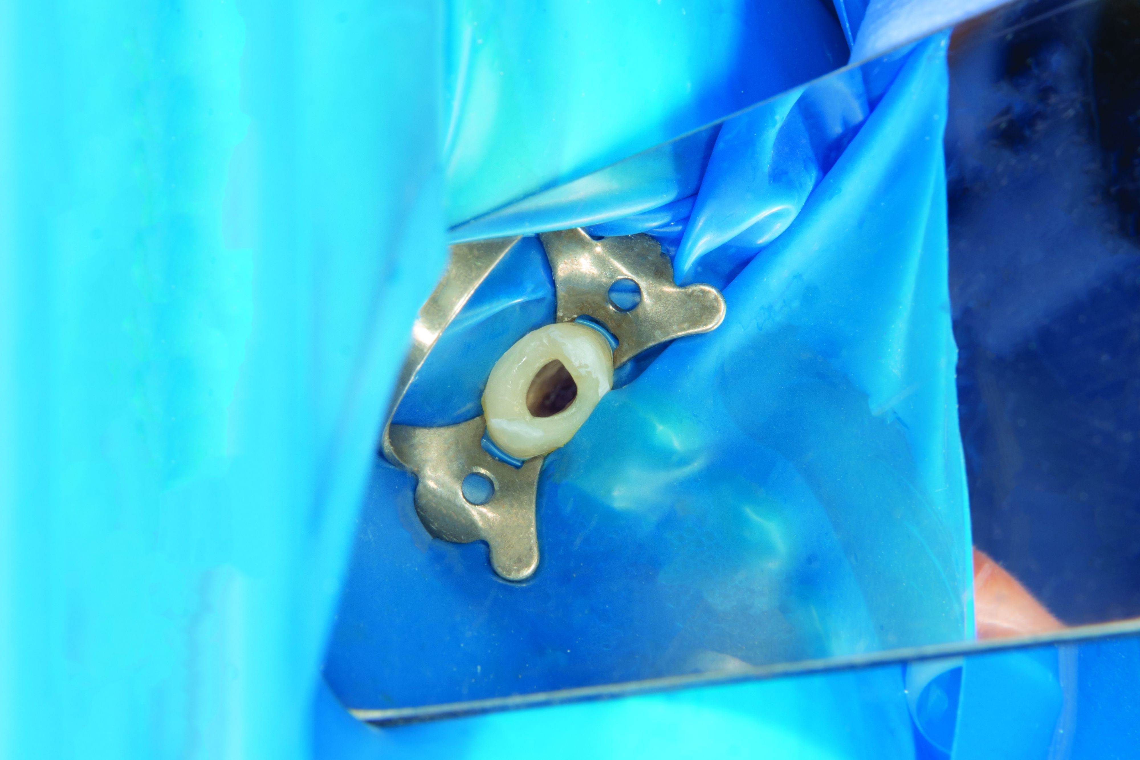 Rubber dam isolation Сергей Кучугурный / stock.adobe.com