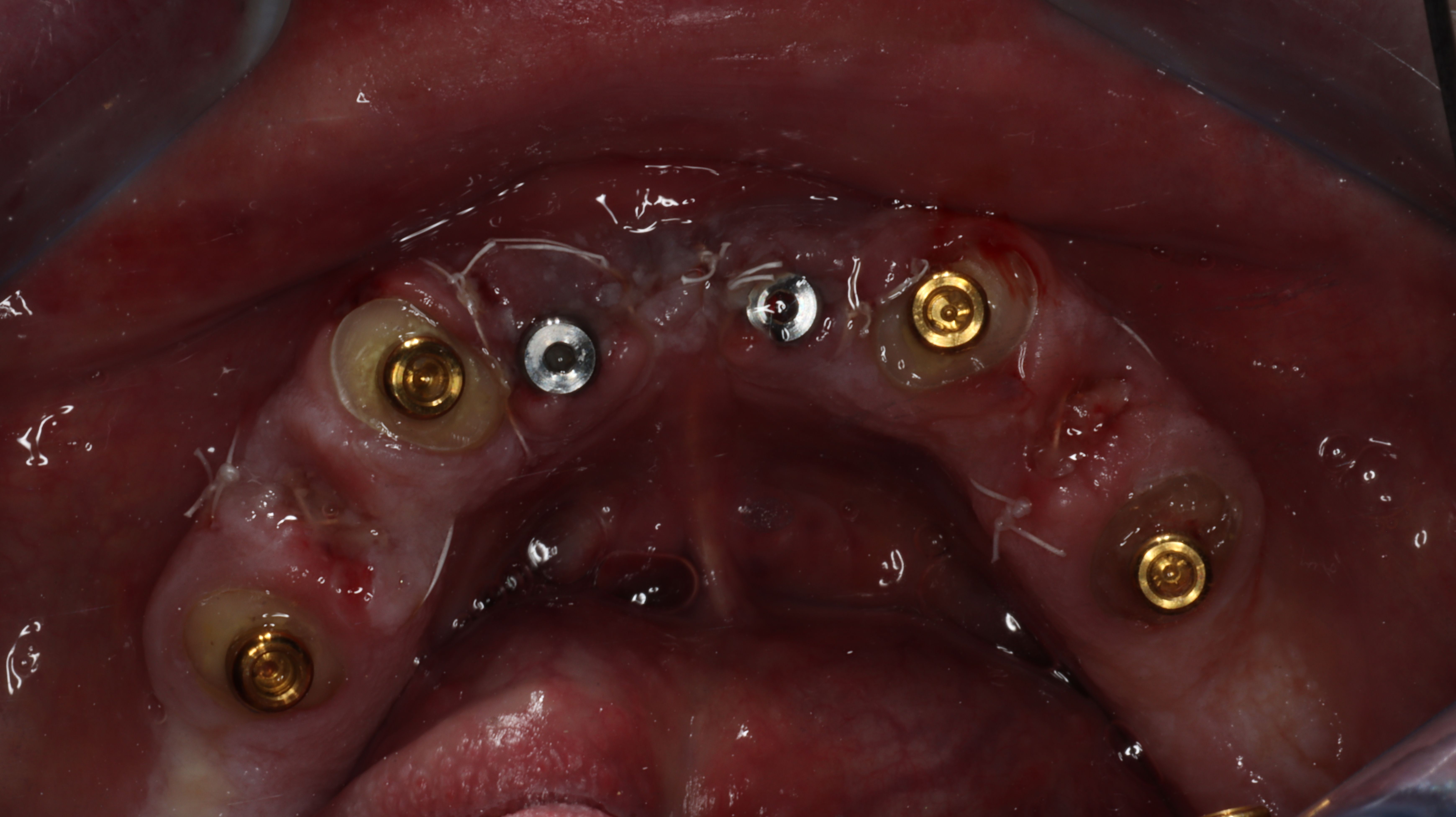 Figure 21. Surgical appointment, extractions of first bicuspids with dentin grind-PRP/PRF bone grafts, locator root form abutments seated into endo teeth and Lodi dental implants placed into anterior symphysis (Zest Dental Solutions).