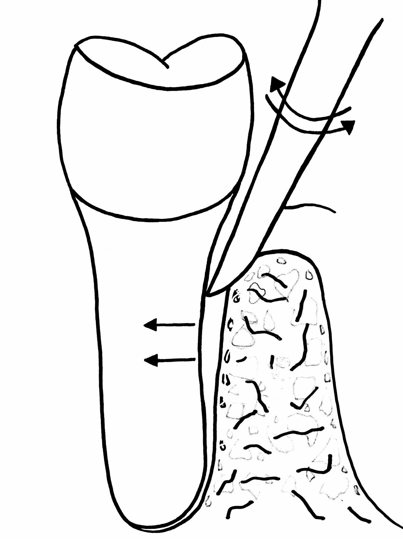 Figure 19. This illustration indicates the proper positioning for using Xpanders from ArtCraft Dental, Inc.