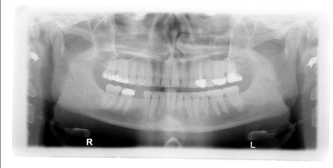 Dr Gupta's original panoramic x-ray on his 37-year-old patient. | Ankur Gupta, DDS