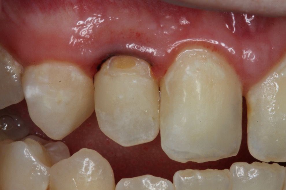 How to Manage Patients With High Caries Risk Using Nonsurgical ...