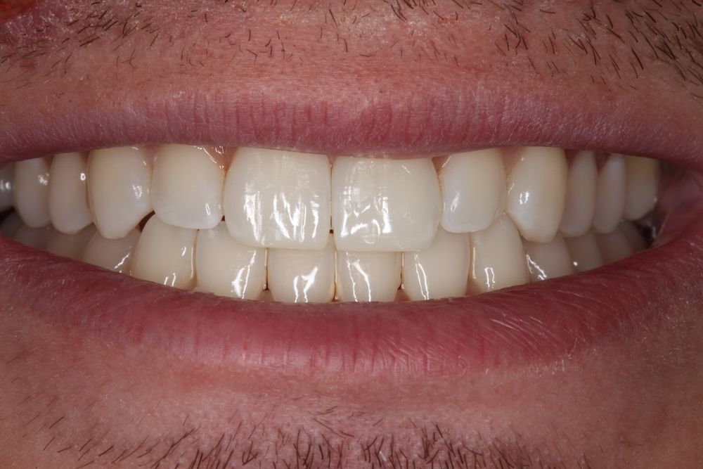completed dental case 