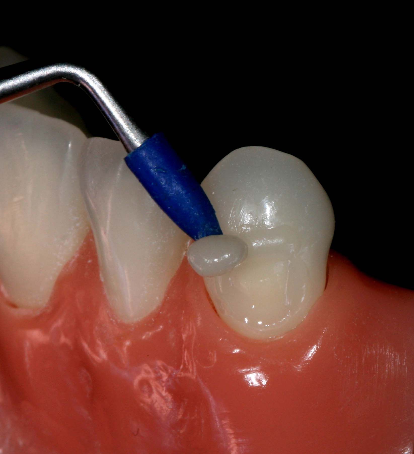 Figure 9. OMNICHROMA initial placement with OptraSculpt