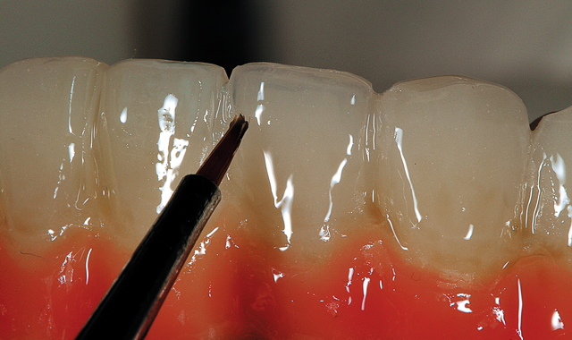 Step 7 He next applied Opal Effect to the incisal 1/3 for a more natural-looking restoration, as shown in this image.