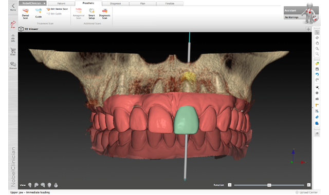 5 Things You Need To Know About Implants