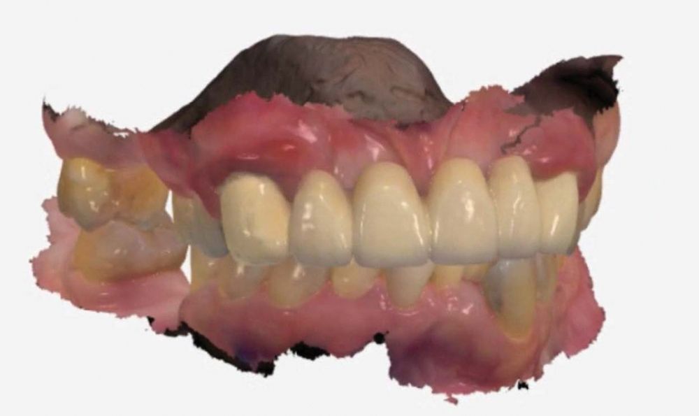 An intraoral scan was obtained for the fabrication of a temporary printed Valplast removable partial denture (RPD) 
